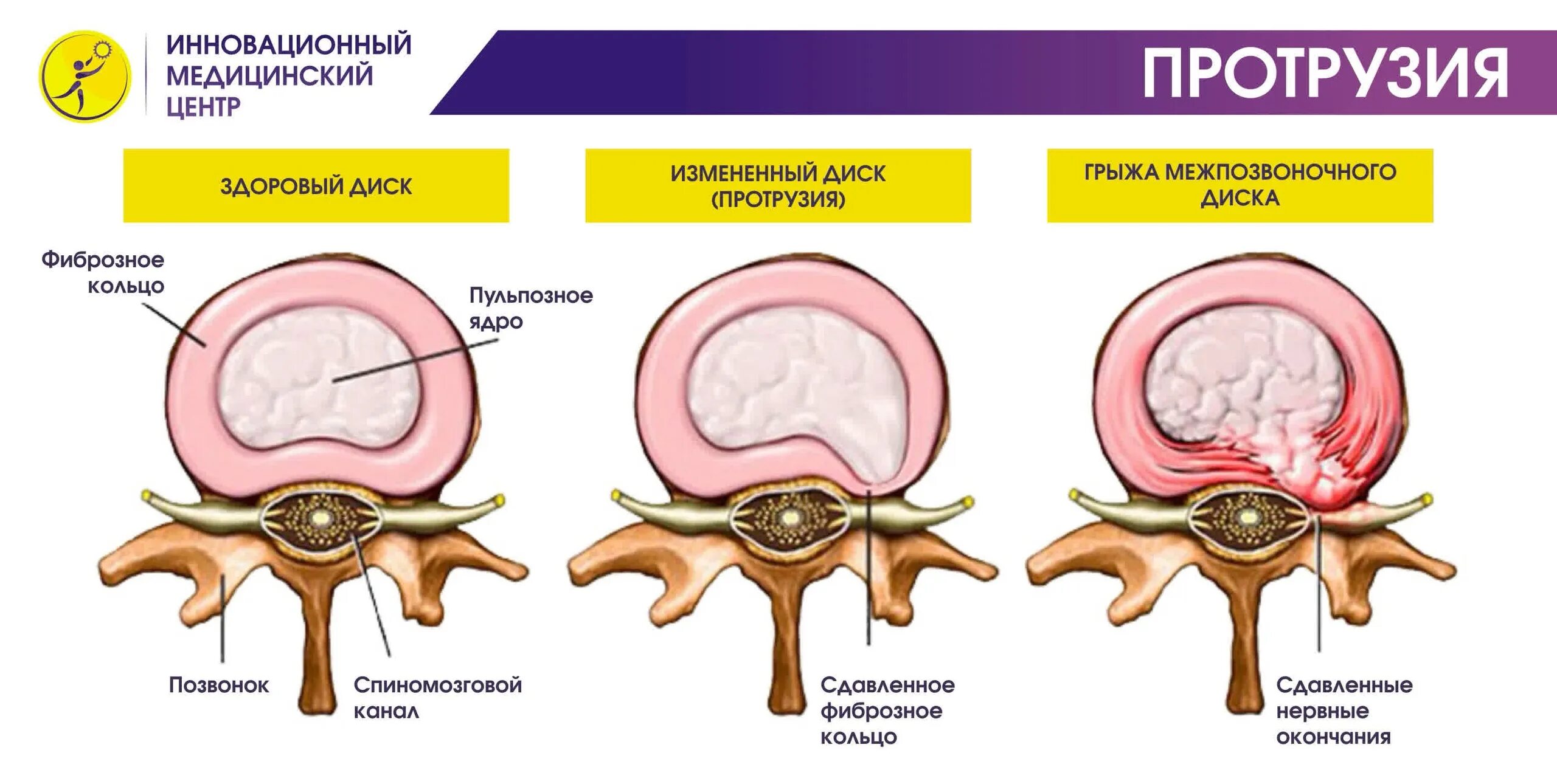 Протрузия дисков фото Операция протрузия позвоночника