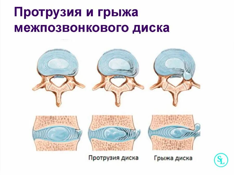 Протрузия дисков фото Боль в области поясницы у женщин, причиняй, виды, лечение в Москве