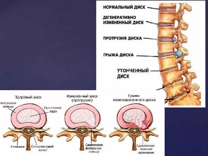 Протрузия дисков поясничного отдела фото Протрузии дисков шейного отдела с5 с7