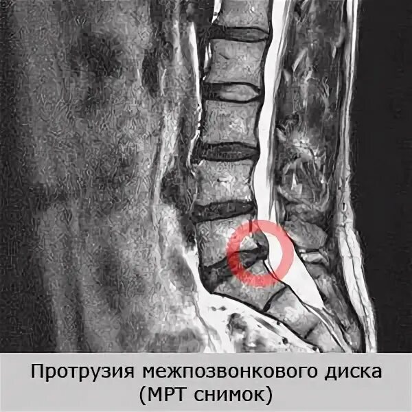 Протрузия дисков поясничного отдела фото Медианная протрузия диска: этиология, операция