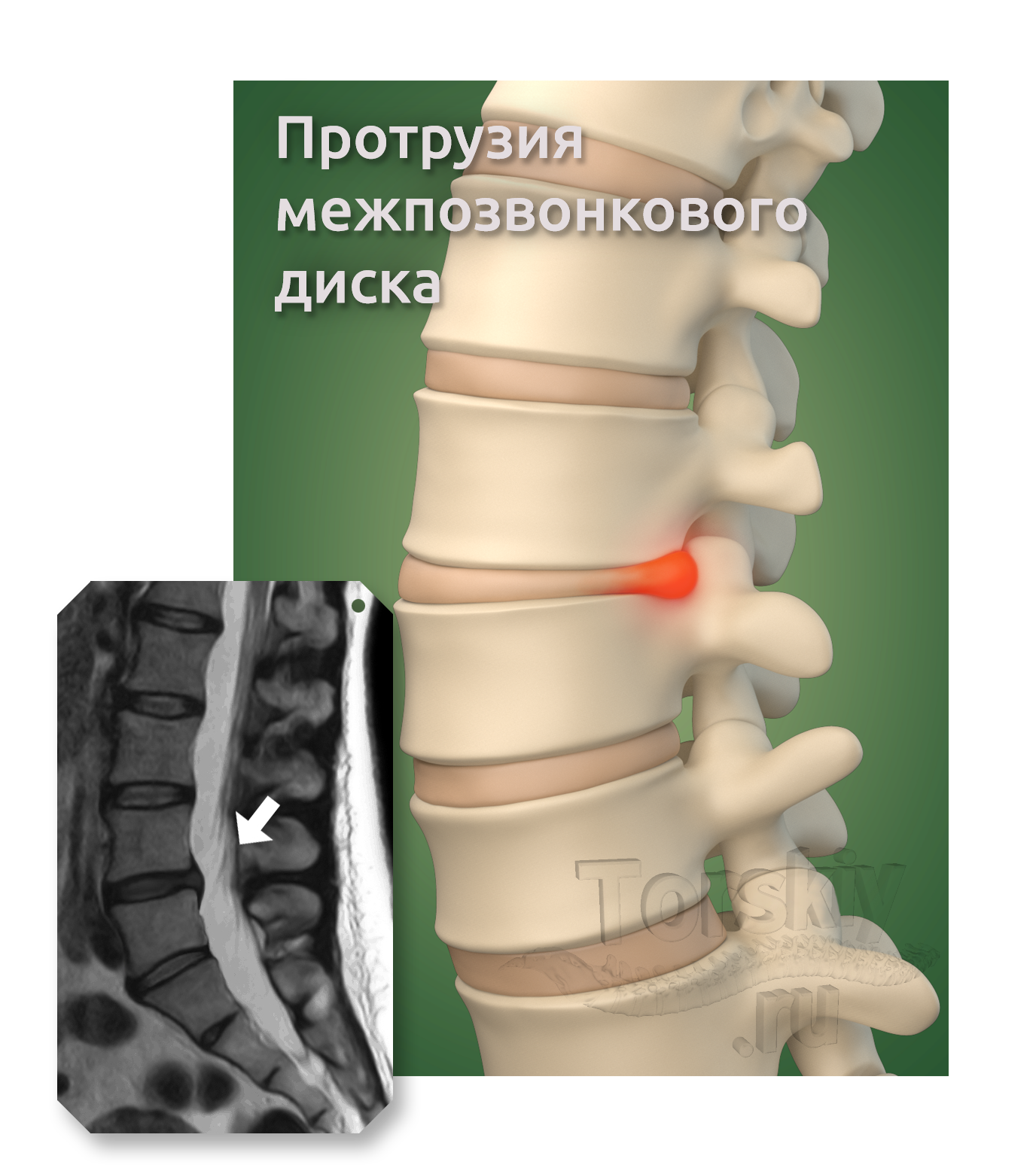 Протрузия дисков поясничного отдела фото Клиника Доктора Торского Протрузия межпозвонкового диска