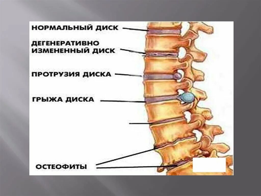 Протрузия дисков поясничного отдела фото Дегенеративные изменения позвоночника протрузии