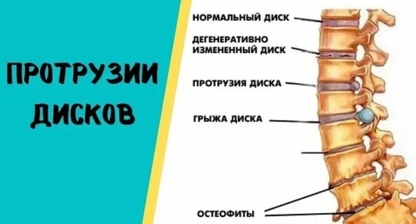 Протрузия дисков поясничного отдела фото У ВАС ПРОТРУЗИИ! МОЖНО, пройти процедуру АКУПРЕССУРУ ПОДЗАТЫЛОЧНЫХ МЫШЦ? Не толь