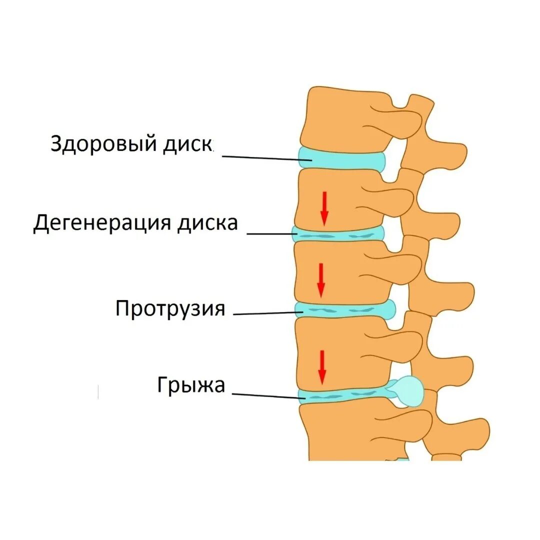 Протрузия дисков поясничного отдела фото Не дайте протрузии превратиться в грыжу Новости медицинского центра Клиника ДНК