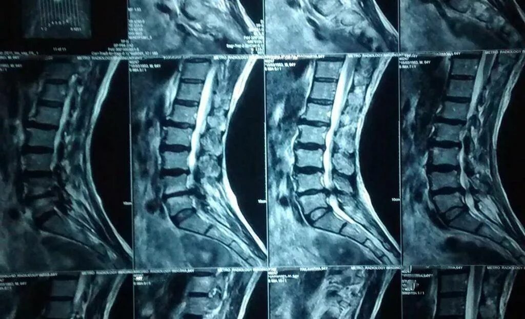 Протрузия дисков поясничного отдела фото Протрузия рентген