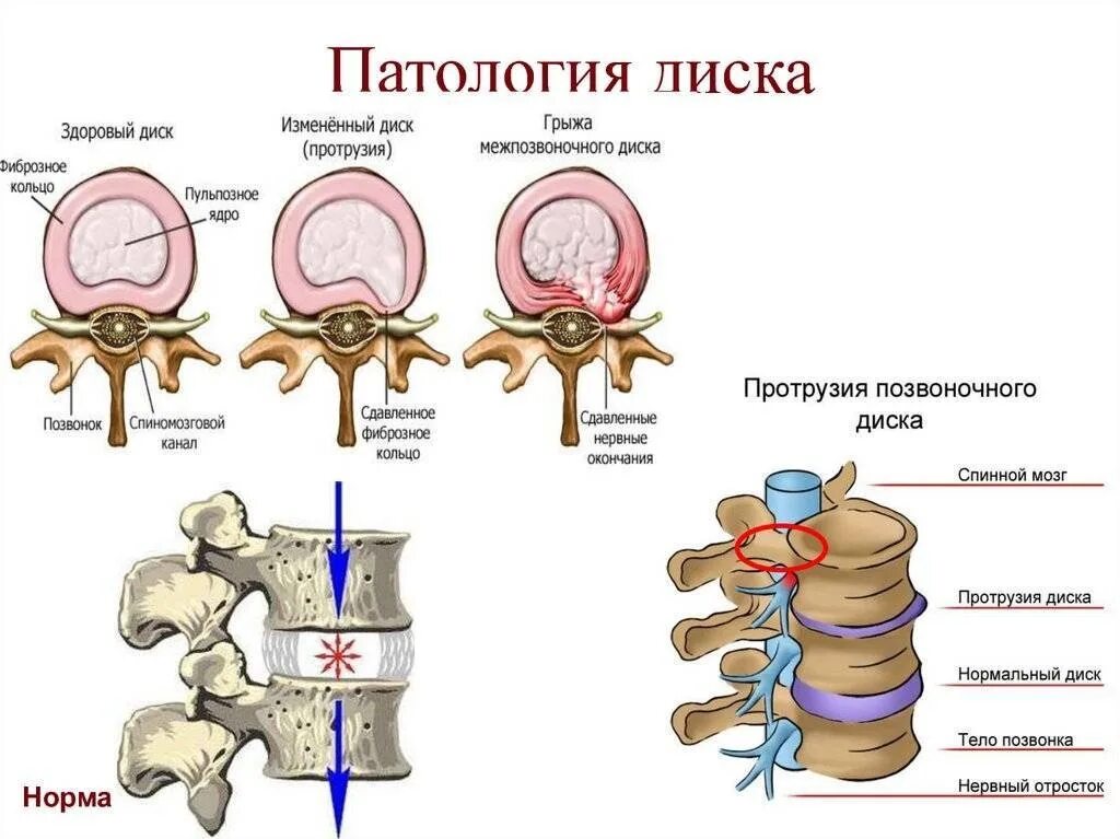 Протрузия дисков поясничного отдела фото Протрузии межпозвонковых дисков размеры