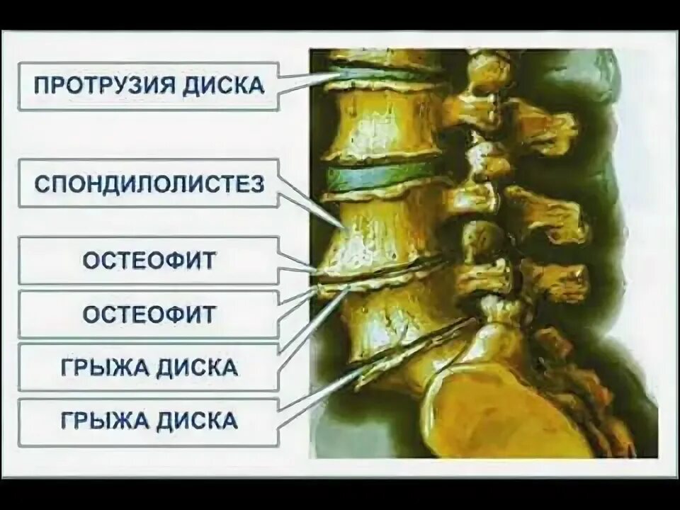 Протрузия дисков поясничного отдела фото Лечение остеохондроза - YouTube