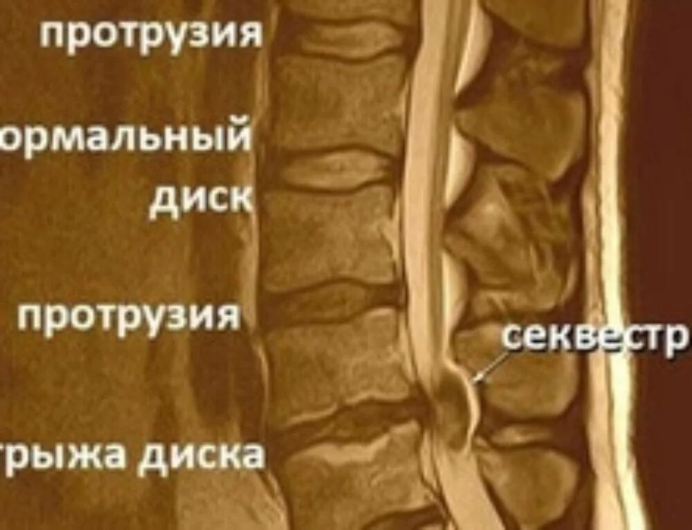 Протрузия дисков поясничного отдела фото Протрузия и экструзия