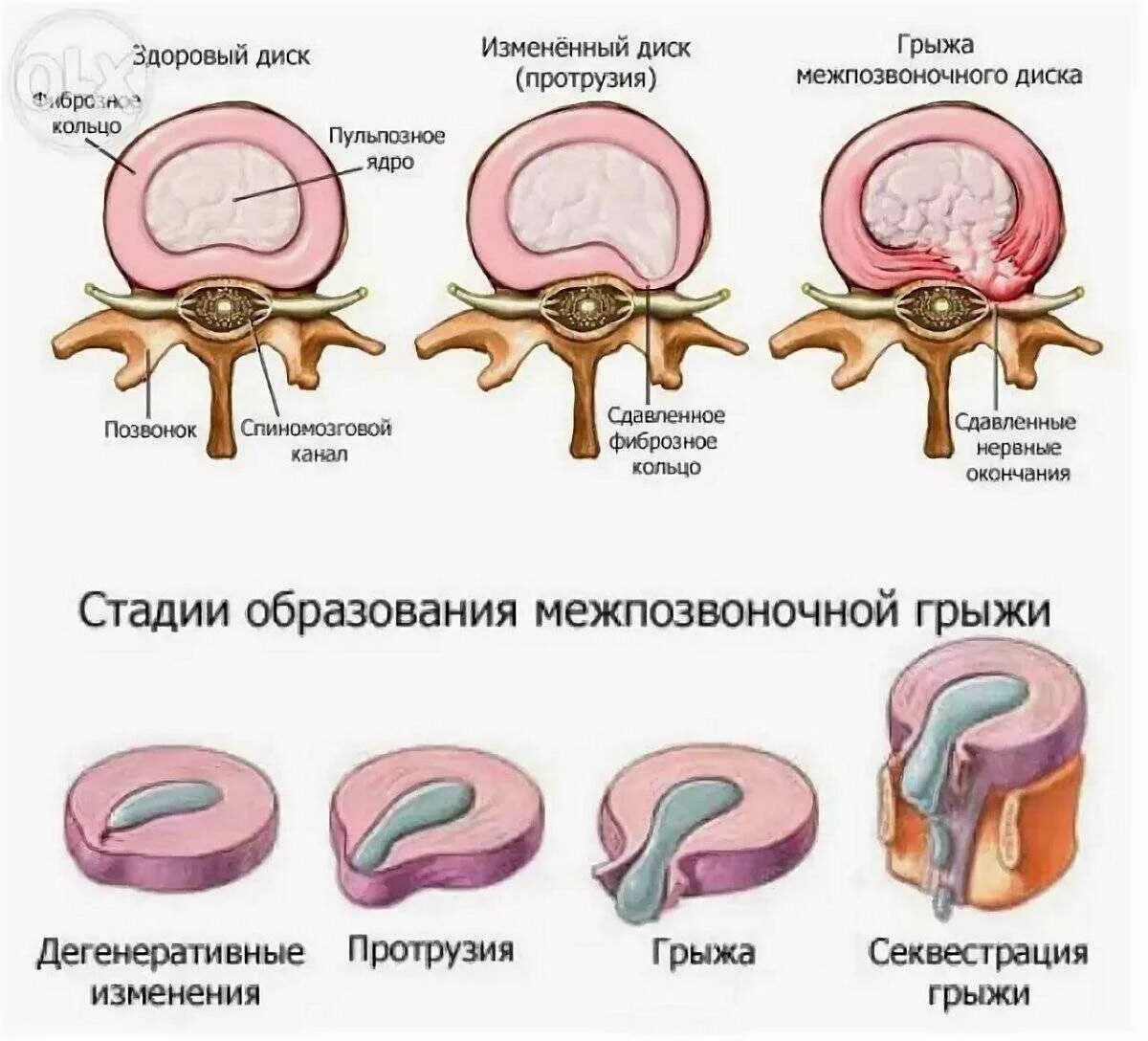 Протрузия дисков позвоночника фото Дорзальная экструзия протрузия