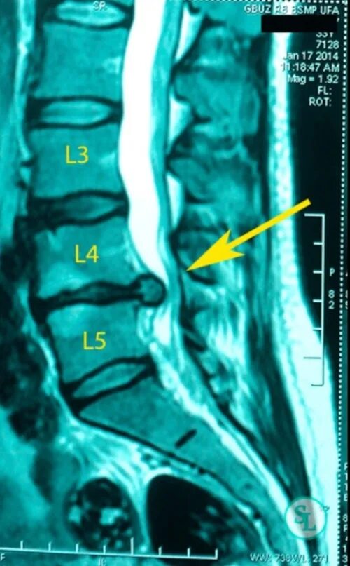 Протрузия дисков позвоночника фото Дорзальная медианная грыжа l5 s1