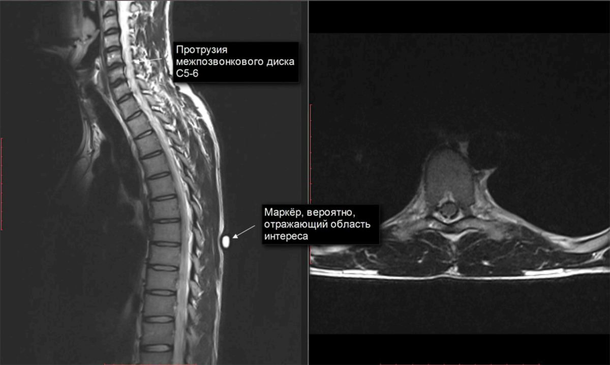 Протрузия дисков позвоночника фото МРТ протрузия межпозвонкового диска Второе мнение