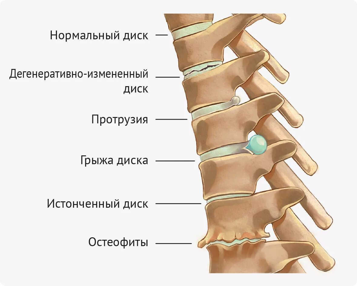 Протрузия поясничного отдела позвоночника фото Лечение болей в спине ударно-волновой терапией