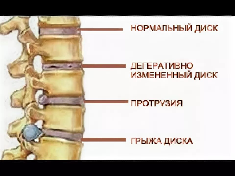 Протрузия поясничного отдела позвоночника фото RAIN и межпозвонковая грыжа - YouTube