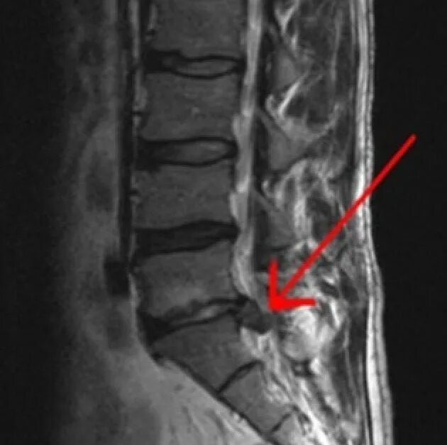 Протрузия шейного отдела фото Lumbociática panosundaki Pin