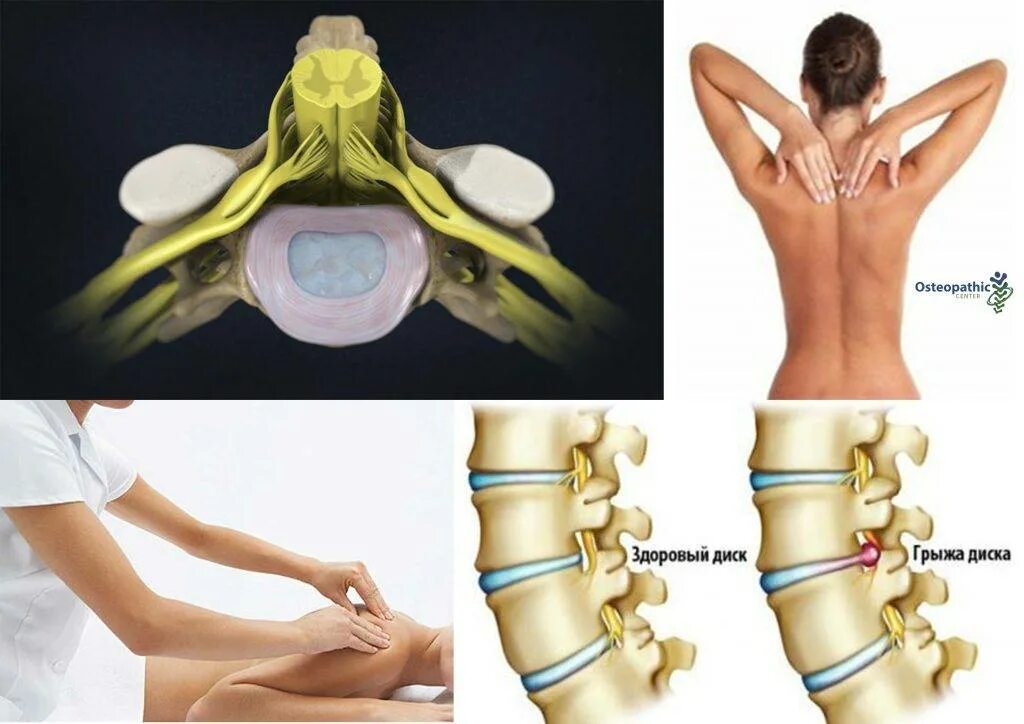 Протрузия шейного отдела фото Что такое протрузия дисков позвоночника и как их лечить упражнениями