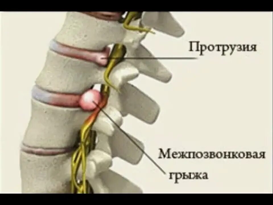 Протрузия шейного отдела позвоночника фото ОТЛИЧНЫЙ РЕЗУЛЬТАТ: ПРОТРУЗИЯ, ГРЫЖА ПОЗВОНОЧНИКА - YouTube