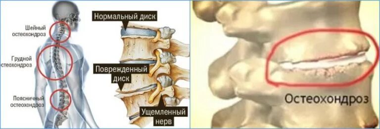Протрузия шейного отдела позвоночника фото Грудной хондроз: симптомы и лечение препаратами, как лечить хондроз грудного отд