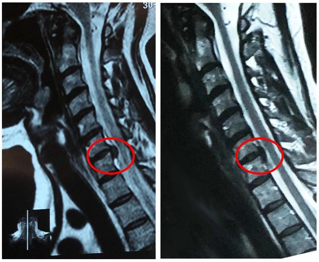 Протрузия шейного отдела позвоночника фото Операция протрузия позвоночника
