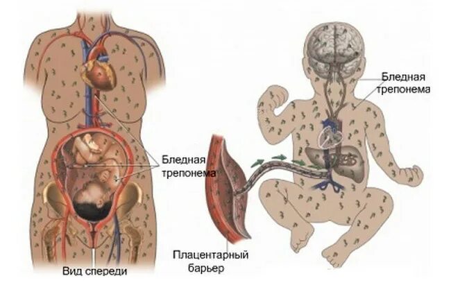 Проявления сифилиса первая стадия фото Внутриутробные инфекции: корь, краснуха, сифилис и СПИД - чем грозят они ребенку