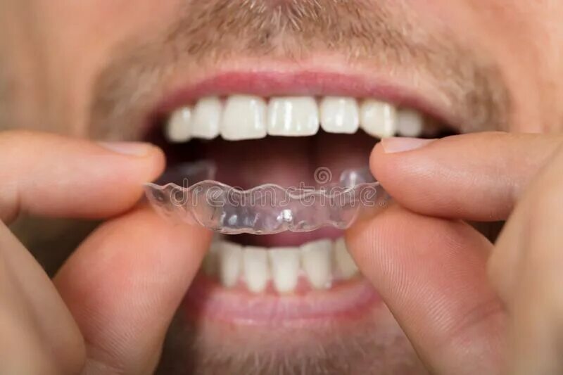 Прозрачные зубы фото Man Putting Transparent Aligner in Teeth Stock Image - Image of implant, invisib