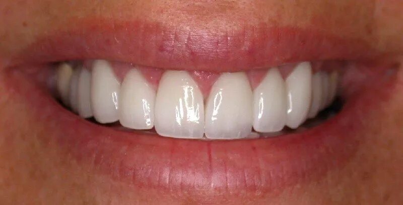 Прозрачные зубы фото Pictures of Porcelain Veneers - Cosmetic Dentistry