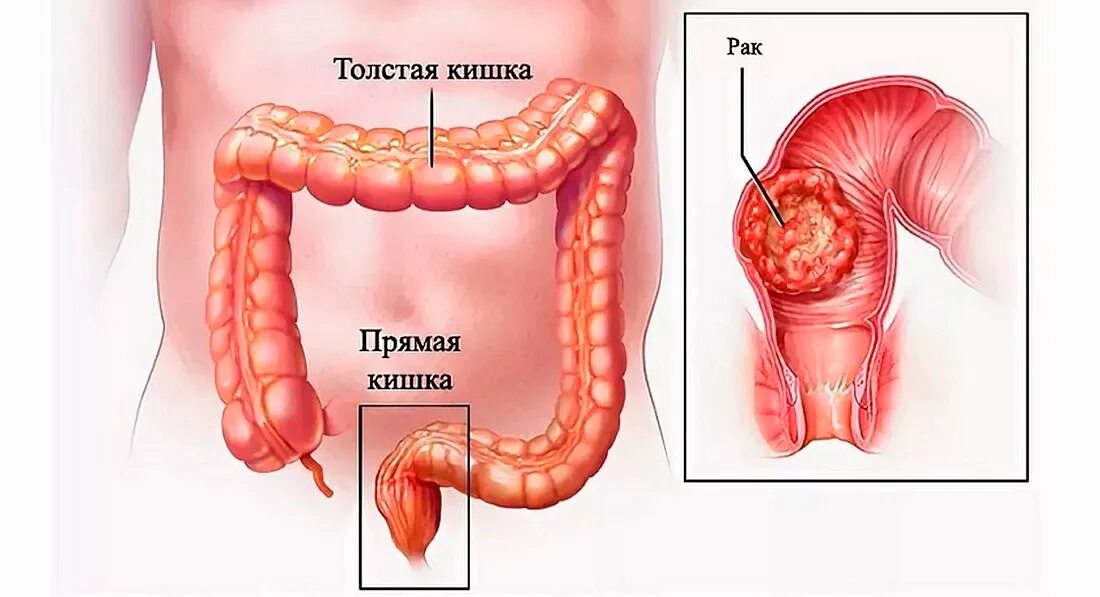 Прямая кишка фото внутри Операция по удалению опухоли в прямой кишке. - Хирург К. В. Пучков