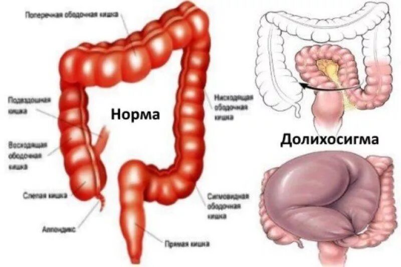 Прямая кишка фото внутри Долихосигма - признаки, причины, симптомы, лечение и профилактика - iDoctor.kz