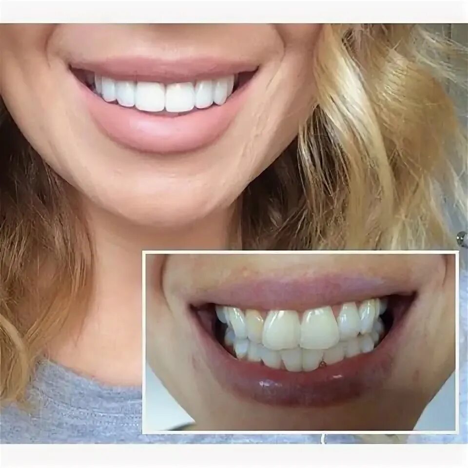 Прямые зубы фото Cosmetic Dentist In Hollywood Smile makeover, Perfect teeth, Cosmetic dentist