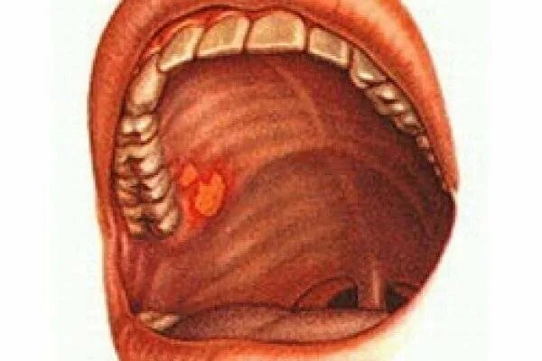 Прыщ на небе во рту фото Картинки на небе красные пятна (69 фото)
