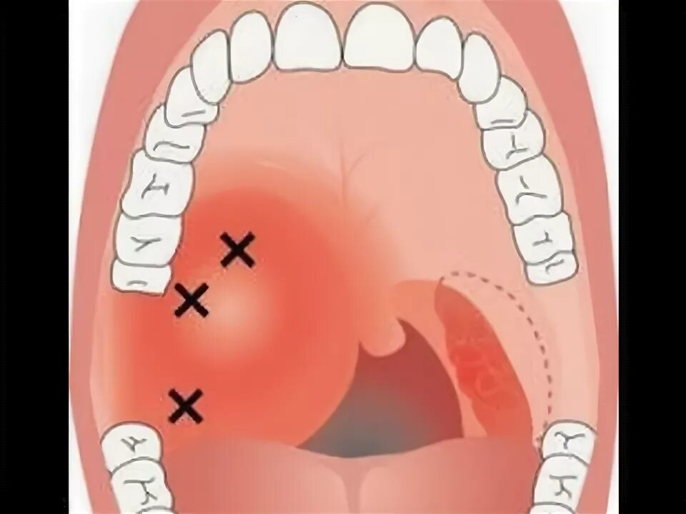 Прыщ на небе во рту фото Quinsy - Peritonsillar Abscess on Endoscopy - YouTube