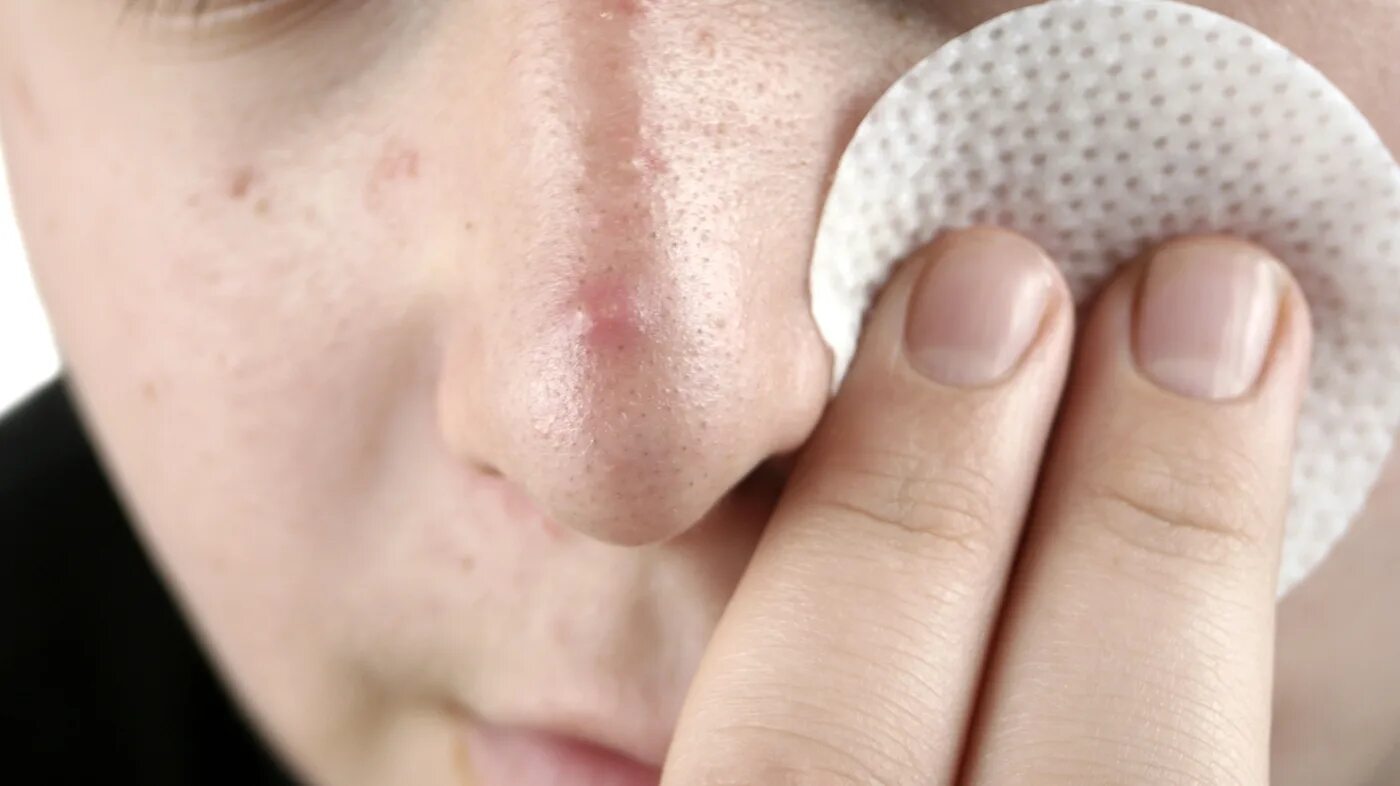 Прыщ синий фото FDA Warns Of Life-Threatening Reactions With Acne Products : Shots - Health News