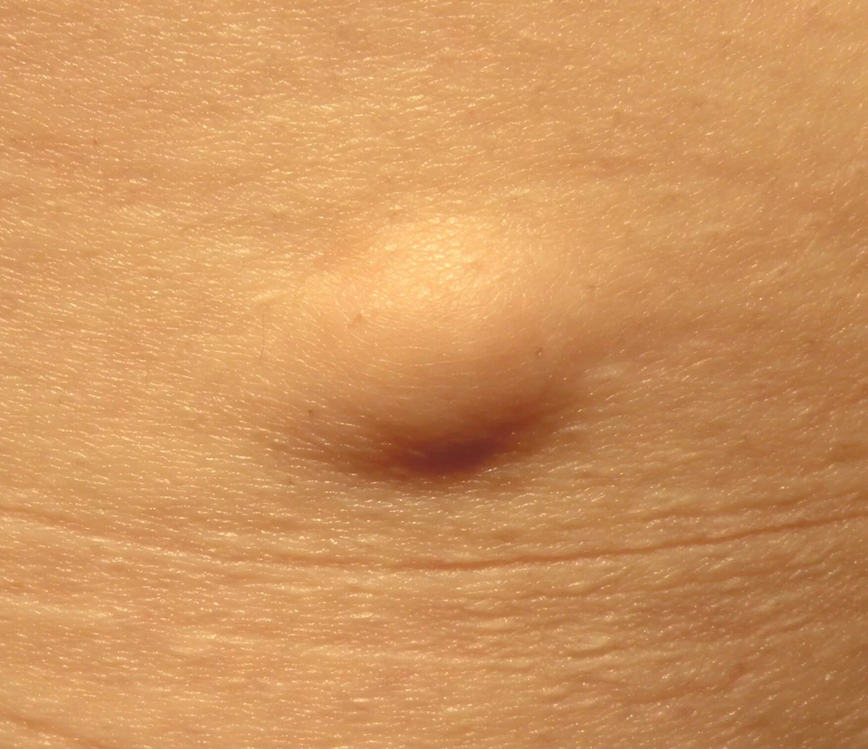 Прыщ внутри фото File:Superficial subcutaneous lipoma.jpg - Wikipedia