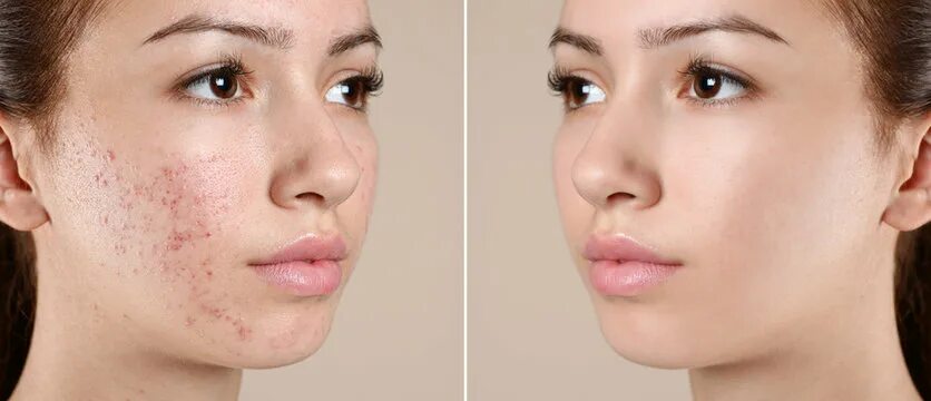 Прыщи до и после фото "Acne Treatment" Изображения: просматривайте стоковые фотографии, векторные изоб