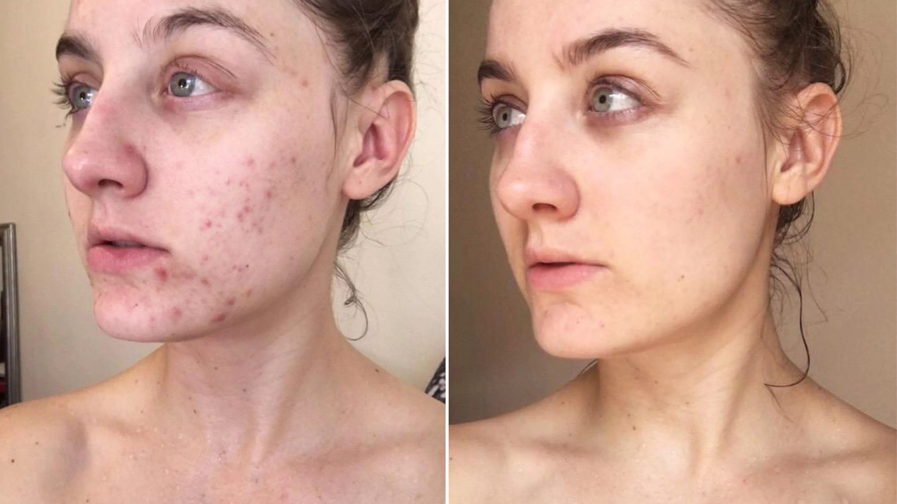 Прыщи до и после фото This Woman Swapped Her Cleanser for Micellar Water - and the Results Are SHOCKIN