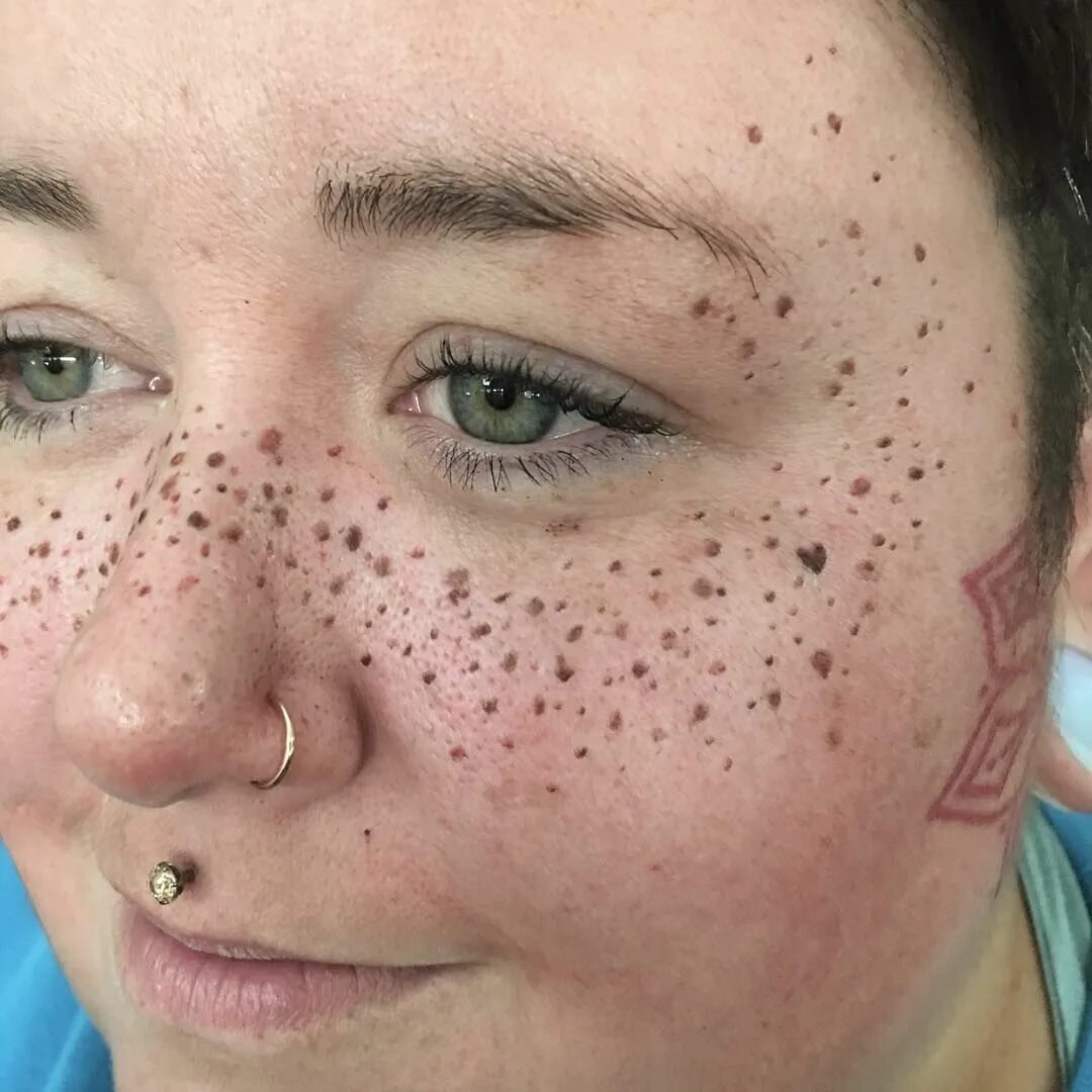 Прыщи на лице у женщин фото Not so subtle freckles If you are a tattoo artist or permanent makeup artist who