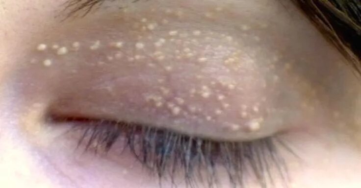 Прыщи на веке фото Strange Bumps Affect Millions, But Treating Them Is As Simple As Rubbing Honey O