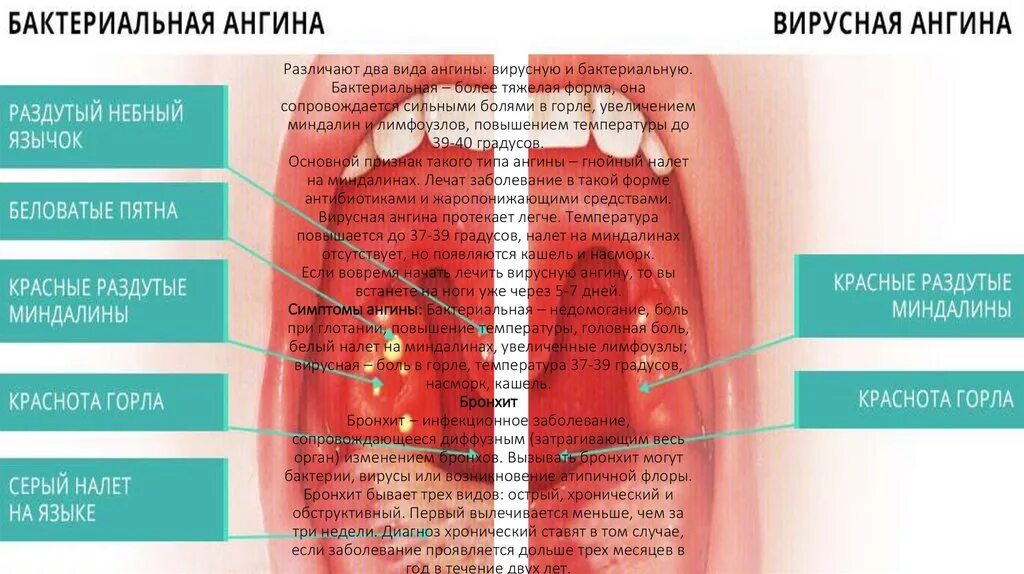 Прыщи на языке у горла фото Картинки ПРИЧИНЫ БОЛИ ГОРЛА И НАСМОРКА