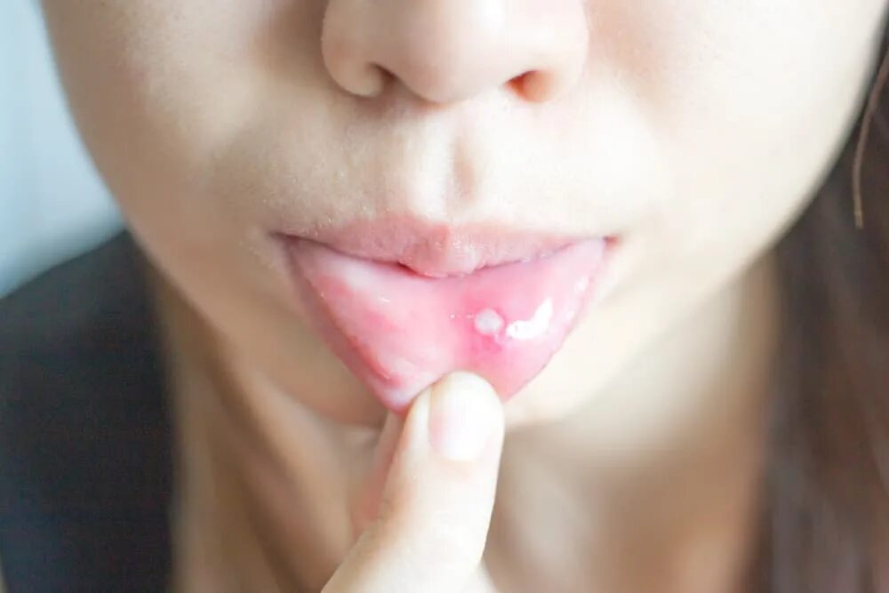 Прыщи на языке у горла фото Find Out What The Appearance Of White Spots On Your Lips Indicates - FamilyToday