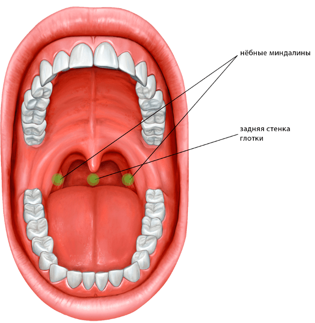 Прыщи на задней стенке горла фото Лечение тонзиллофарингита. Заболевание горла