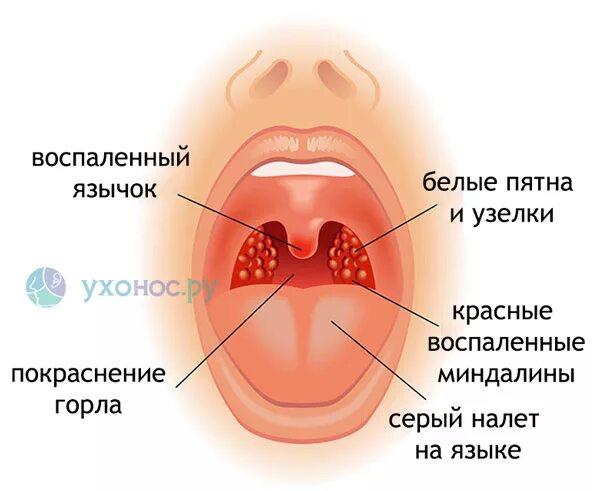 Прыщи на задней стенке горла фото У грудничка белый прыщик на небе: возможные причины, методы терапии и профилакти