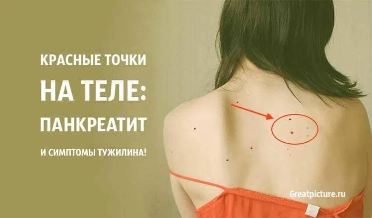 Прыщи при заболевании печени фото Красные точки на теле: Панкреатит и симптом Тужилина in 2024 Herbal medicine, Me