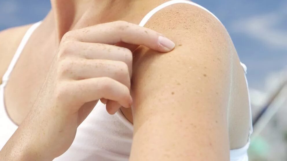 Прыщи при заболевании печени фото How to Perform a Self-Exam For Skin Cancer - ABC News