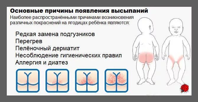 Прыщик на попе у ребенка фото Сыпь на попе у ребенка: фото с пояснениями - Авито - Абхазия