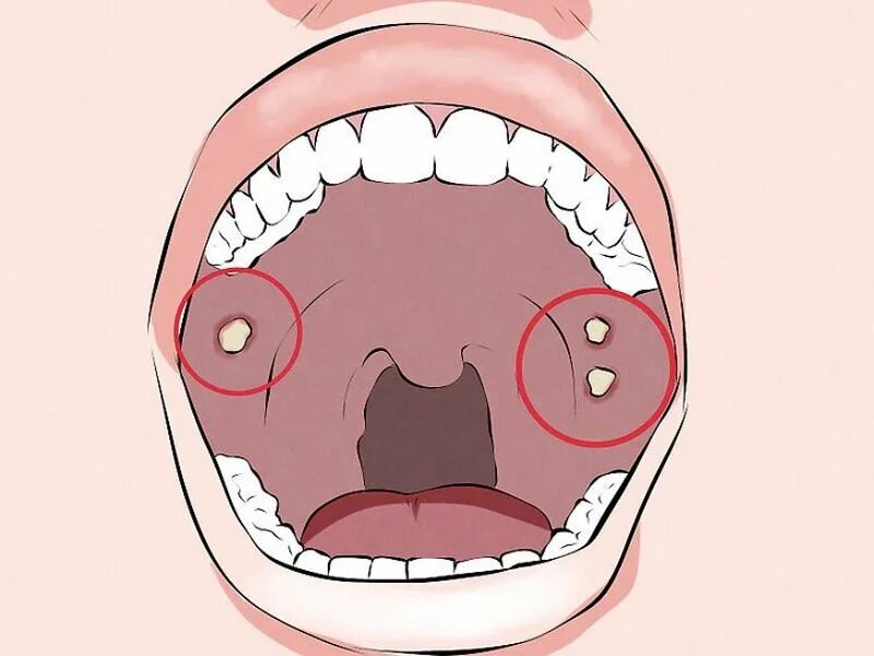Прыщики на небе во рту фото Диагностика опухолей полости рта