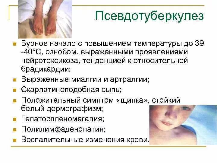 Псевдотуберкулез симптомы фото Псевдотуберкулез у детей: 6 предрасполагающих факторов, 5 групп симптомов, метод