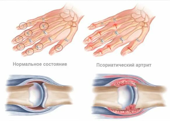 Псориатический артрит симптомы фото Псориатический артрит: причины, симптомы и лечение в статье эндокринолога Бабинц