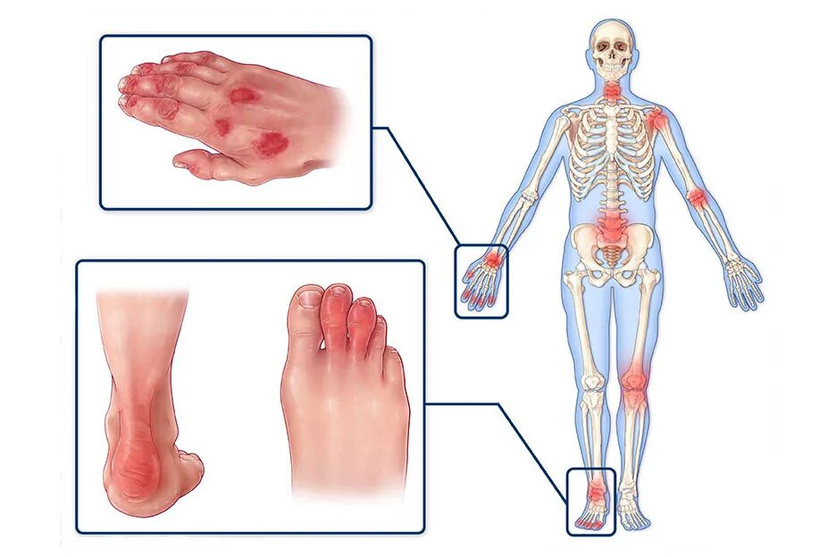 Псориатический артрит симптомы и лечение фото Псориатический артрит - диагностика и лечение по доступным ценам в Челябинске