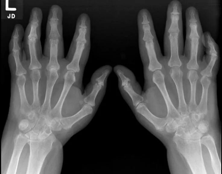 Псориатический артрит симптомы и лечение фото Psoriatic Arthritis X Ray Check more at http://www.nhprimecare.org/psoriatic-art