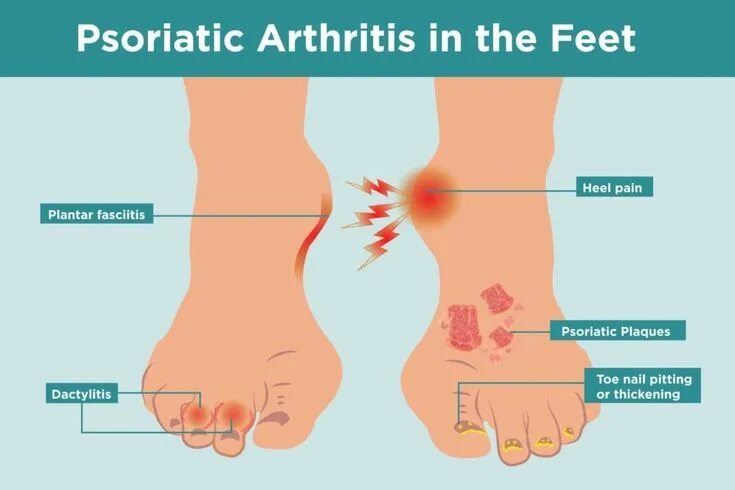 Псориатический артрит симптомы и лечение фото Pin on diabetic