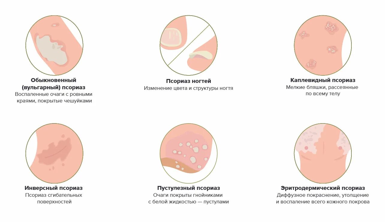 Псориаз фото на коже начальная стадия Псориаз на руках - Vitimed